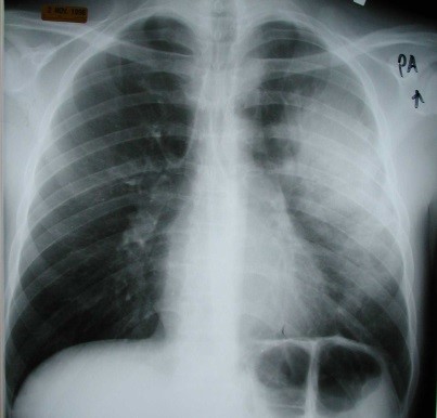 chest x-ray